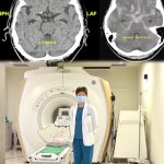 基醫腦血管健檢 助解除中風危機