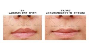 寵物當家毛孩擬人化後遺症 抓咬飼主唇部白疤有救