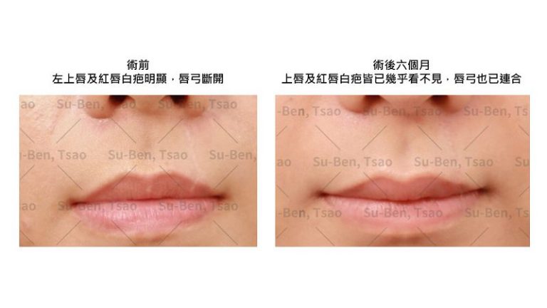 寵物當家毛孩擬人化後遺症 抓咬飼主唇部白疤有救