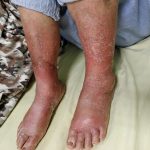 北榮桃園分院：下肢紅腫未必是蜂窩性組織炎