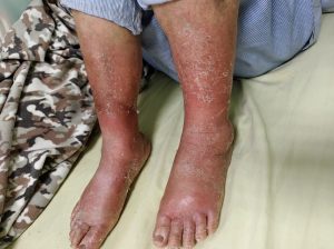 北榮桃園分院：下肢紅腫未必是蜂窩性組織炎