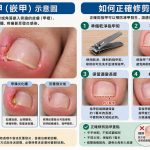 凍甲不只是小問題 大林慈院提醒反覆發炎更難治