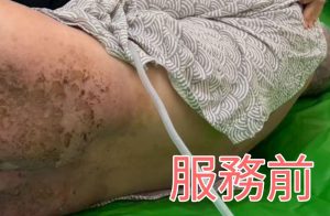從厚重皮屑到清爽肌膚，創世助失能臥床者找回尊嚴