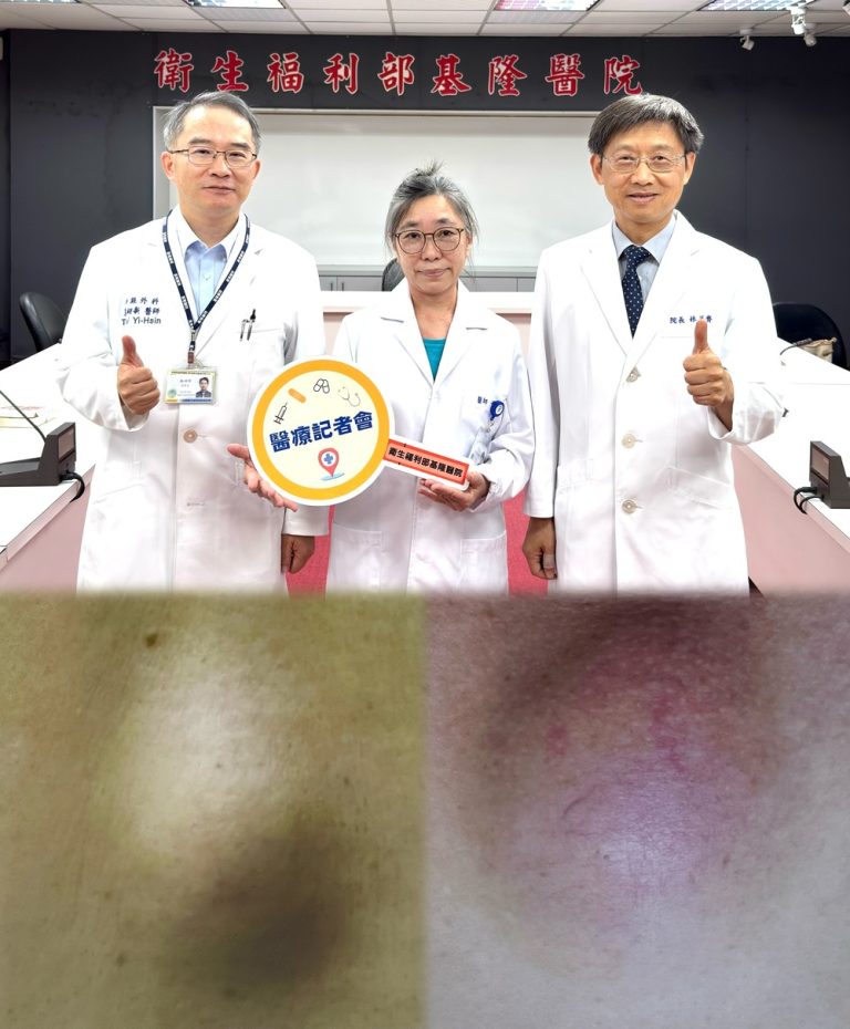 粉瘤不是青春痘 切勿自行亂擠