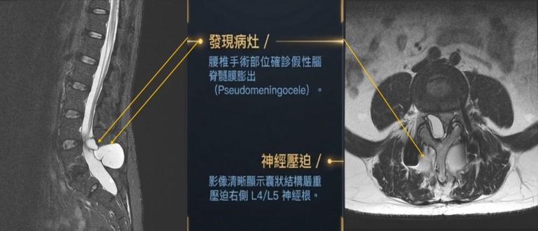 腳踏地如針扎、站不起！六旬男腰椎術後痛2年 MRI揪假性囊腫作祟